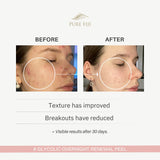 Glycolic Overnight Renewal Peel with Mandelic + Niacinamide (1oz/30ml)